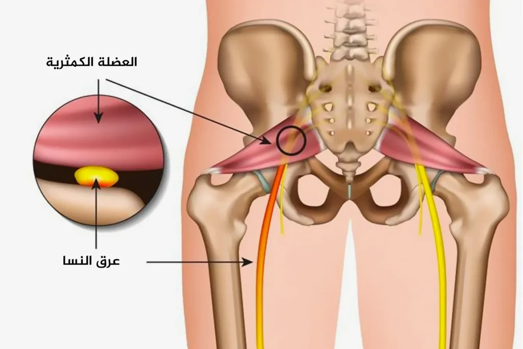 التهاب-العصب-الوركي-عرق-النسا-الأسباب