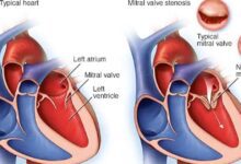 دراسة: جراحات السمنة تُخفض خطر الإصابة بأمراض القلب