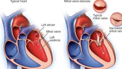 دراسة: جراحات السمنة تُخفض خطر الإصابة بأمراض القلب