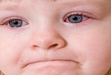 تعرف على متلازمة جفاف العين عند الأطفال