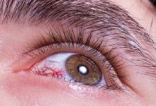 ما متلازمة العين الراقصة وطرق علاجها؟