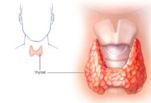 انخفاض الحرارة.. مخاطر الغدة الدرقية الخاملة وشرب الكحوليات