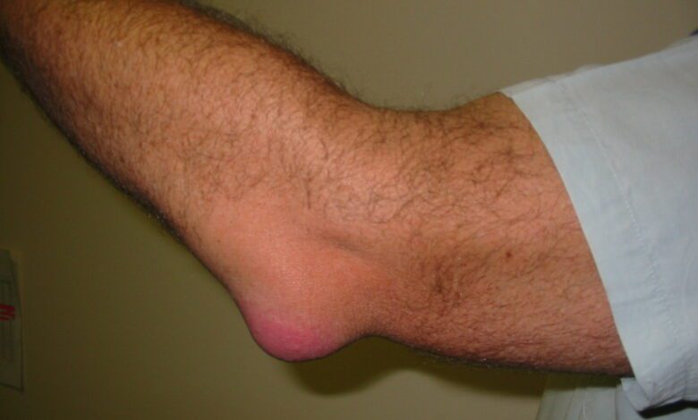 Bursitis Elbow WC 1