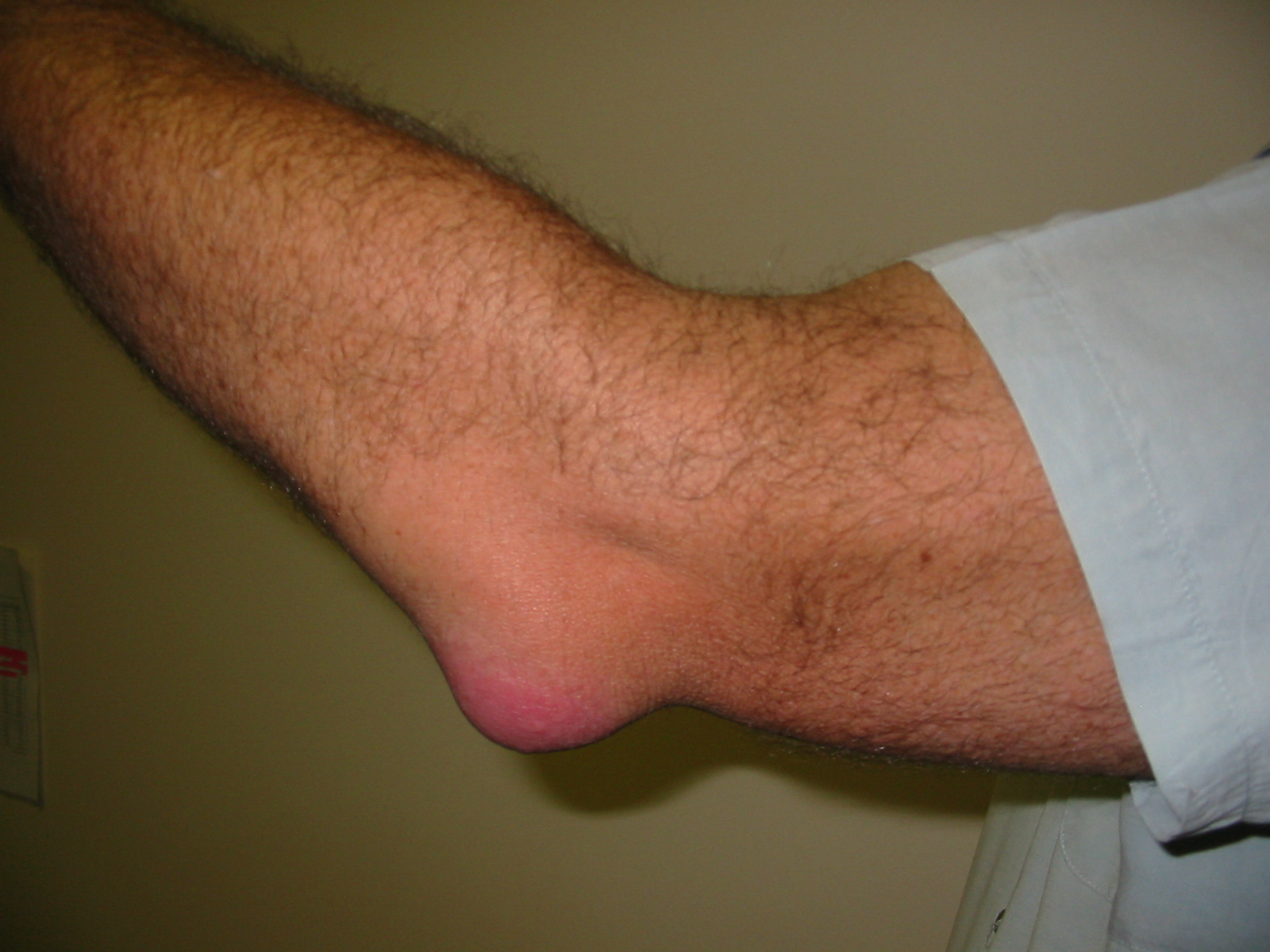 Bursitis Elbow WC 1