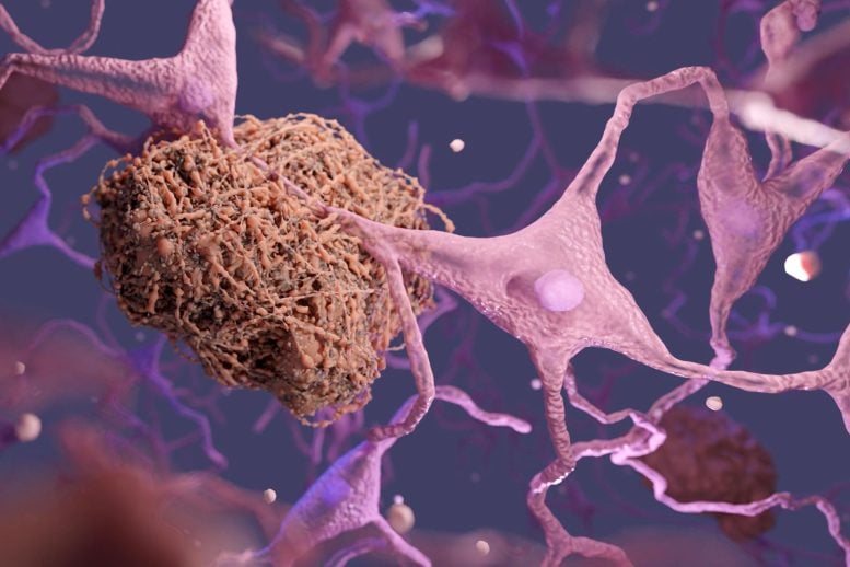 الدماغ الخرف الخلايا العصبية اميلويد البلاك مرض الزهايمر