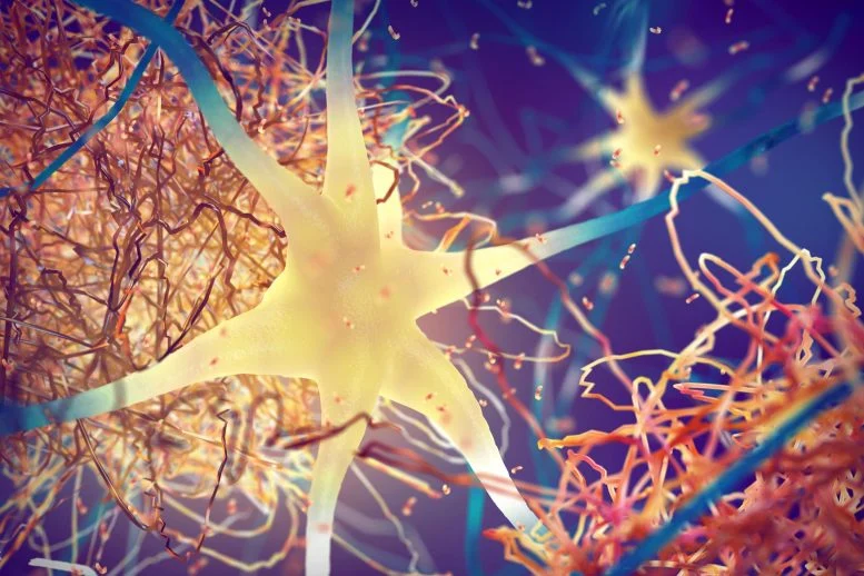 Amyloid Plaques Forming Between Brain Neurons 777  215 518 jpg