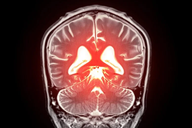 Dementia Diagnostics MRI Brain Scan 777  215 518 jpg