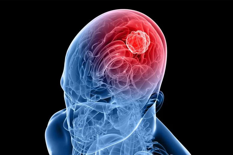 اكتشف الباحثون نقطة ضعف محتملة في أحد أخطر أنواع سرطان الدماغ