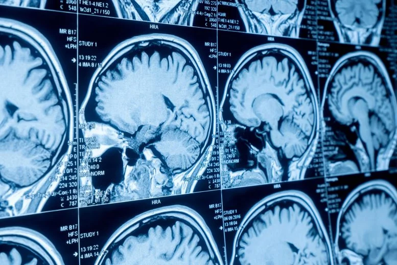 دراسة تربط شيخوخة الدماغ المبكرة ببكتيريا الأمعاء لدى بالغين أصحاء