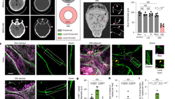 Osteoclasts intercept meningeal lymphatic paths for dural metastasis