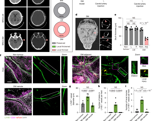Osteoclasts intercept meningeal lymphatic paths for dural metastasis