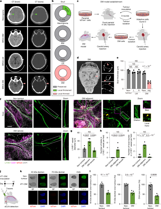 Osteoclasts intercept meningeal lymphatic paths for dural metastasis - صورة مميزة Osteoclasts intercept meningeal lymphatic paths for dural metastasis