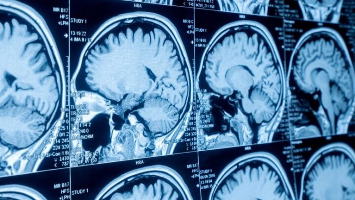 دراسة تربط شيخوخة الدماغ المبكرة ببكتيريا الأمعاء لدى بالغين أصحاء