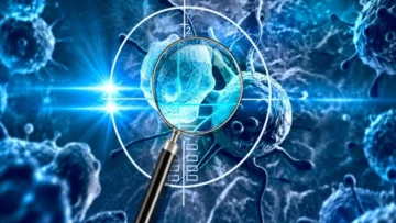 الذكاء الاصطناعي يكتشف العلامات التحذيرية الخفية من سرطان المثانة لمدة تصل إلى 5 سنوات قبل التشخيص